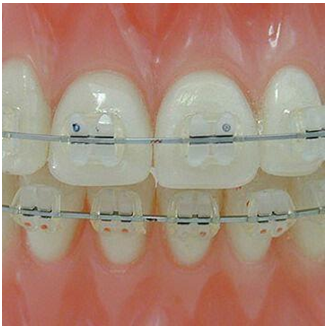 Aparelho ortodôntico invisível: corrigir os dentes sem aparelho fixo é  possível - Ortodontia Curitiba